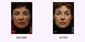 Plasma Resurfacing Plasma Resurfacing
