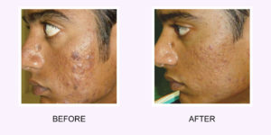 Acne Scars Before & After