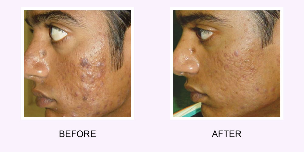 Acne Scars Before & After