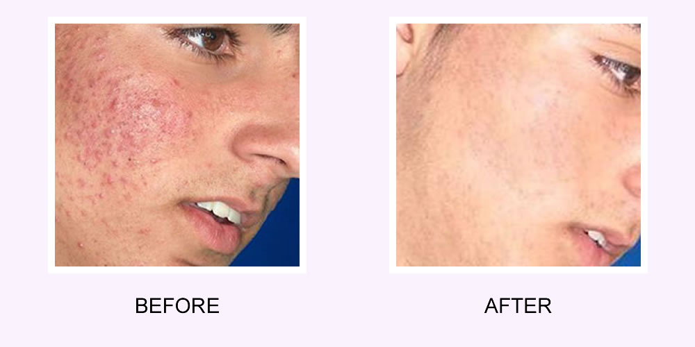 Acne Scars Before & After