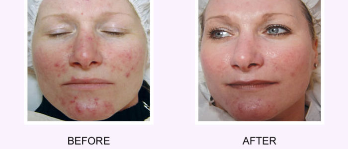 Acne Scar Removal on a Face Before & After