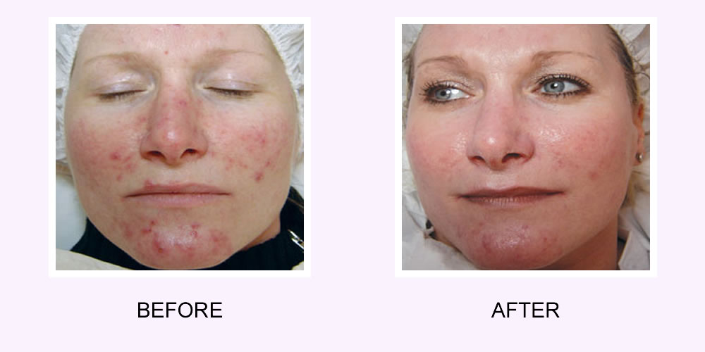 Acne Scar Removal on a Face Before & After