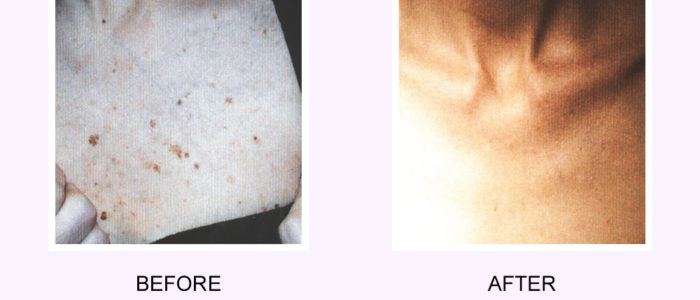 Before and After Acne Scar Removal