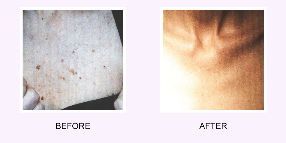 Before and After Acne Scar Removal