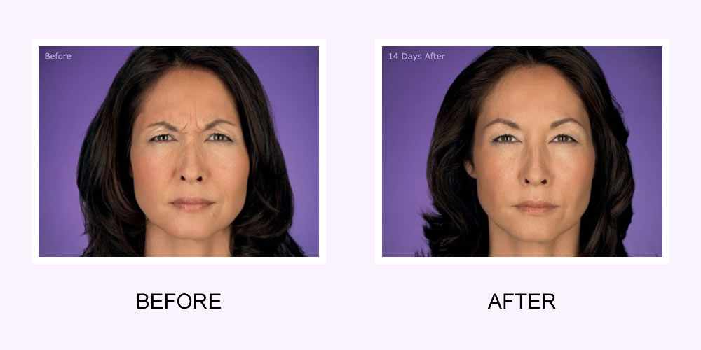 Botox Female Face Before and After