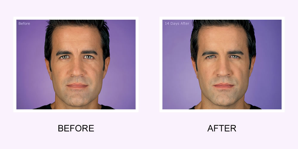 Botox Male Face Before and After