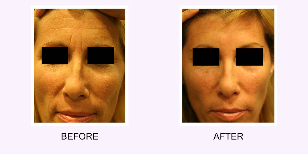 Dermal Fillers Before & After