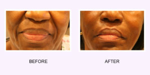 Injectable Dermal Fillers Before and After