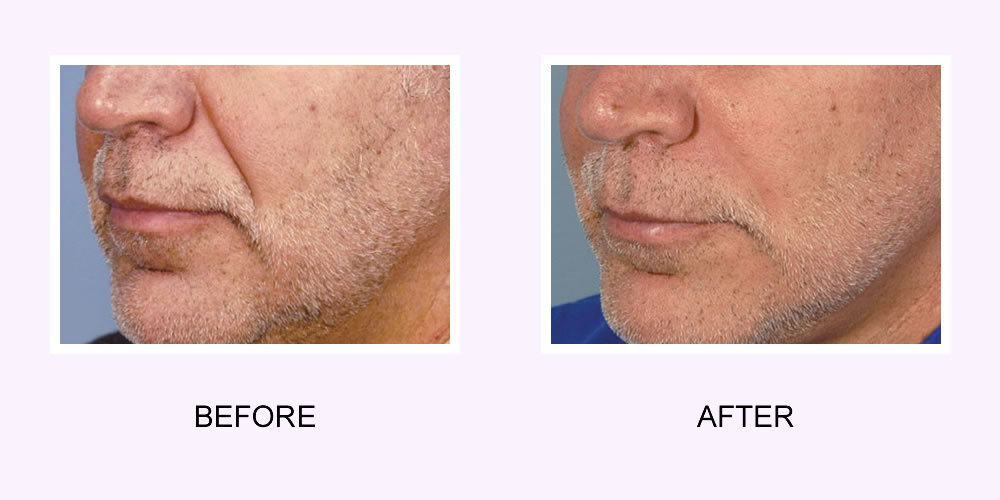 Dermal Fillers Before & After