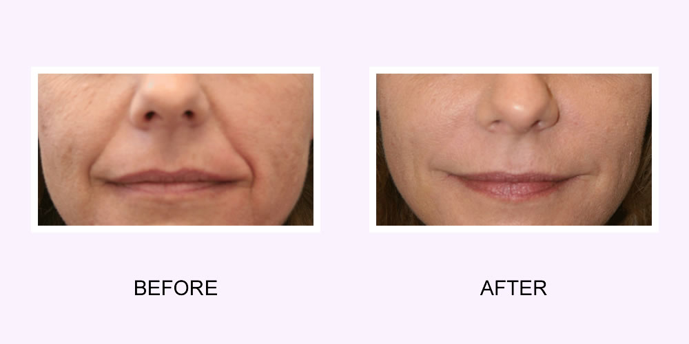 Dermal Fillers Before & After