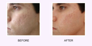 Fractional Resurfacing Before and After