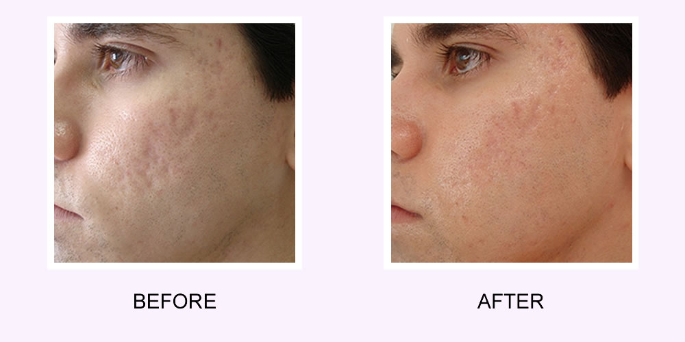 Fractional Resurfacing Before & After