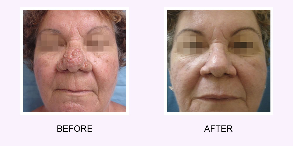Fractional Resurfacing