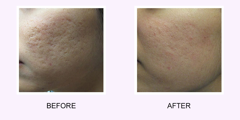 Fractional Resurfacing Before & After