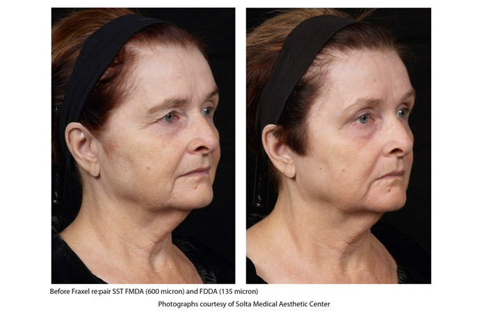 Fraxel Before & After