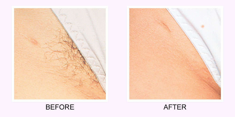 Laser Hair Removal Before & After