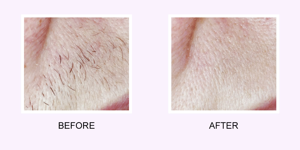 Upper Lip Hair Removal Before & After