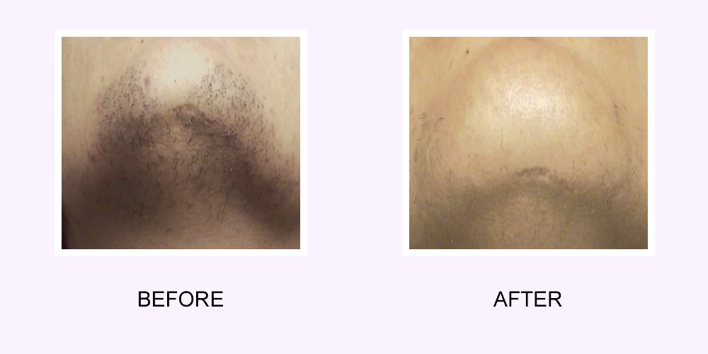 Laser Hair Removal Before & After