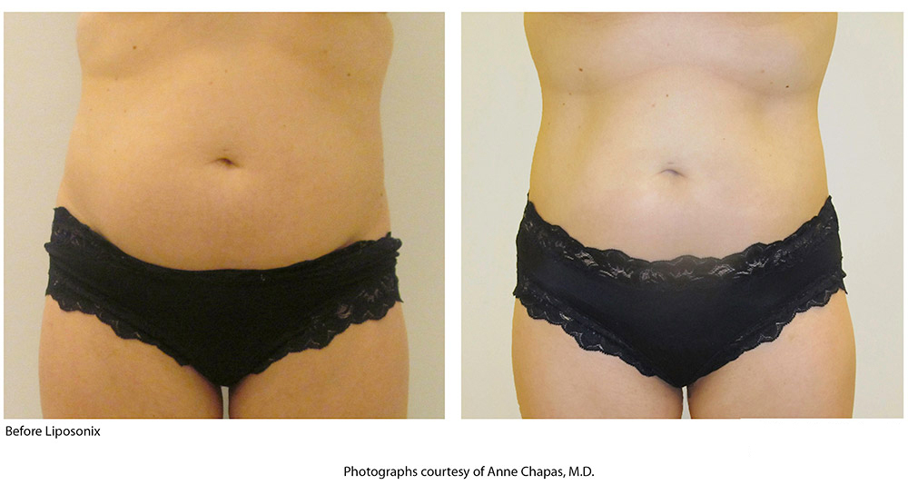 Liposonix Before and After