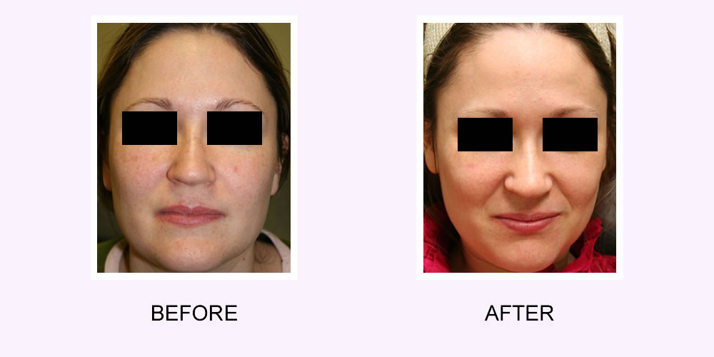 Photo Rejuvenation Before and After