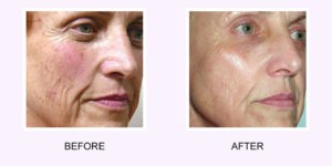 Photo Rejuvenation Before & After