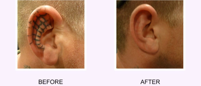 tattoo removal results Before & after for leg & feet laser tattoo
removal results