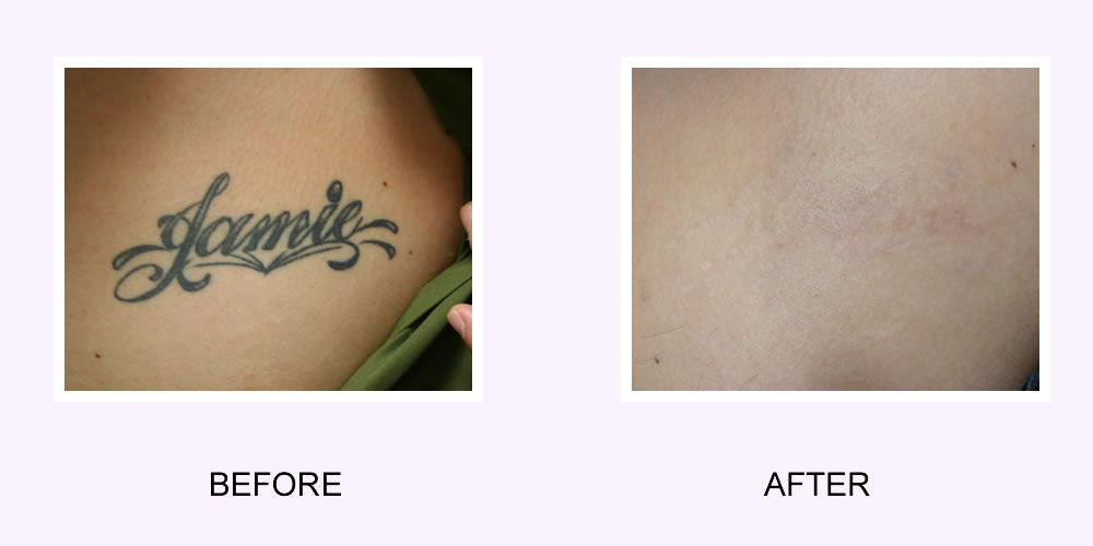 Funky Tattooz - Before after camera tattoo 📷 By... | Facebook