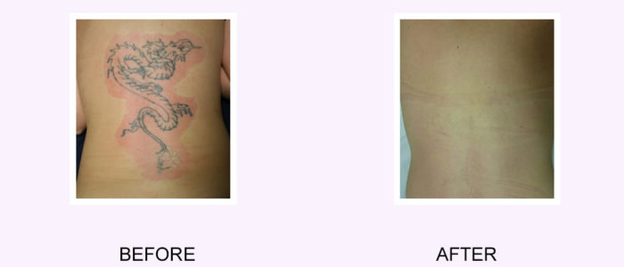 tattoo removal