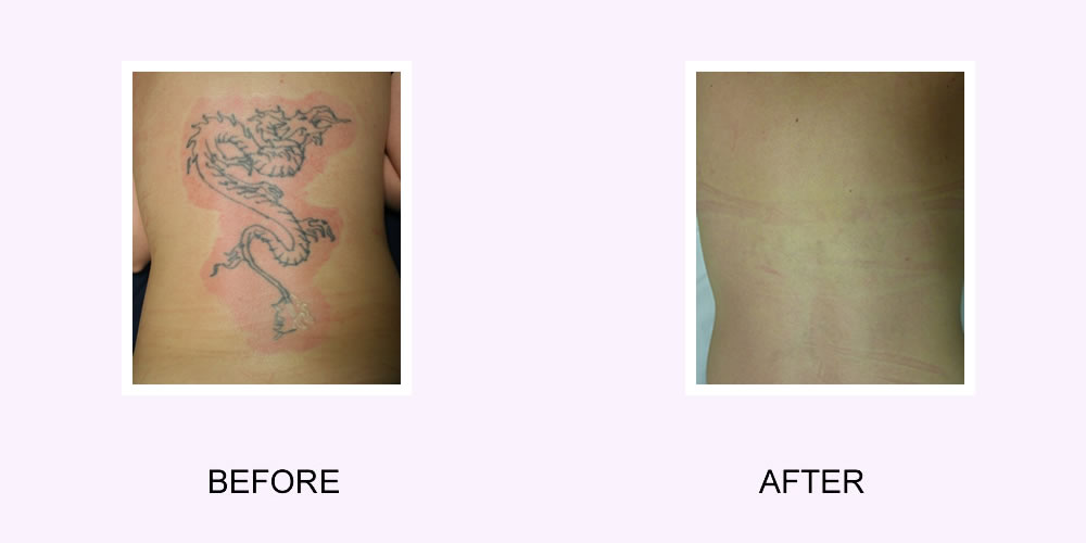 How Much Does Laser Tattoo Removal Cost in North Hollywood   pureskinlasercentercom