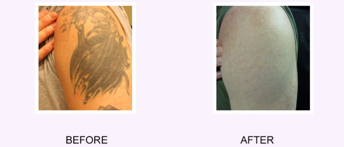 tattoo removal