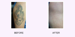 Before and After Tattoo Removal