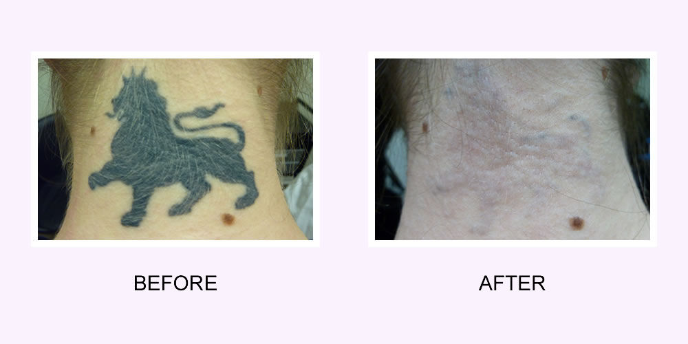 Lion Tattoo Removal Before and After