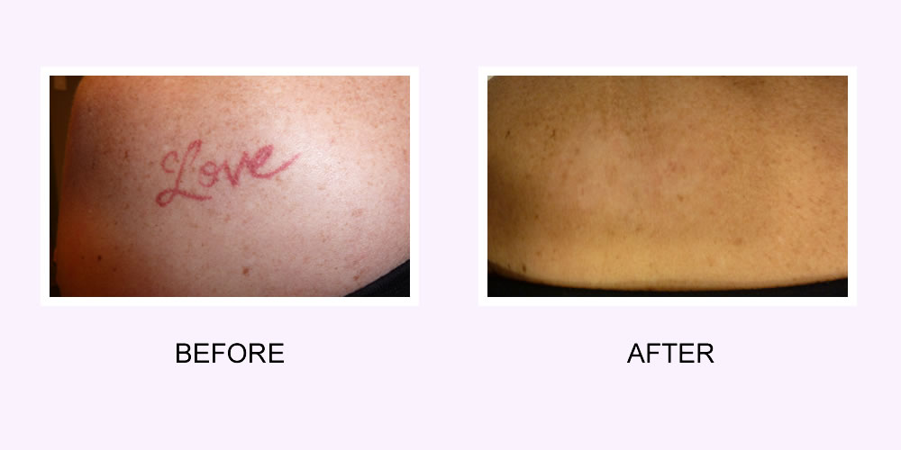 Tattoo Removal Before & After