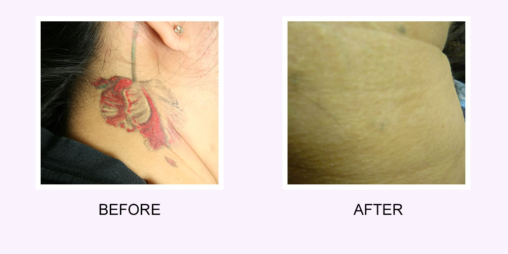 How much tattoo can tattoo removal really remove?