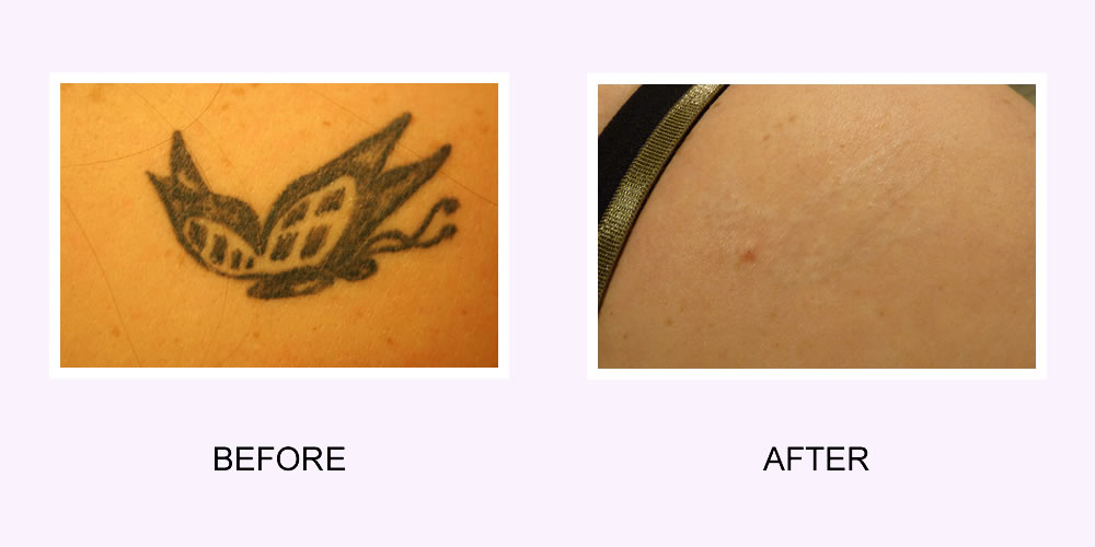 Butterfly Tattoo Removal Before and After