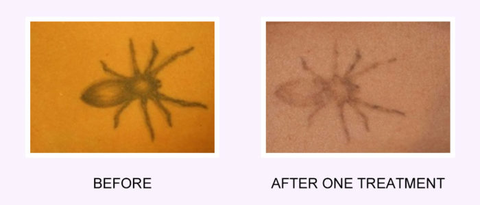 tattoo removal