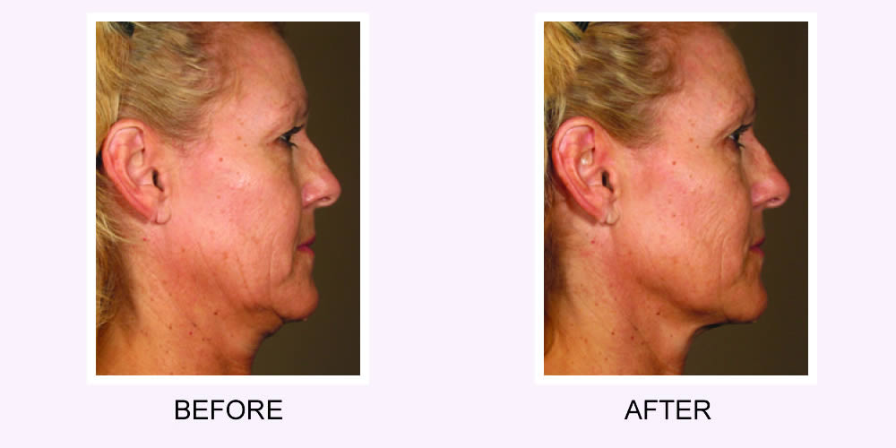 Ultherapy Before and After