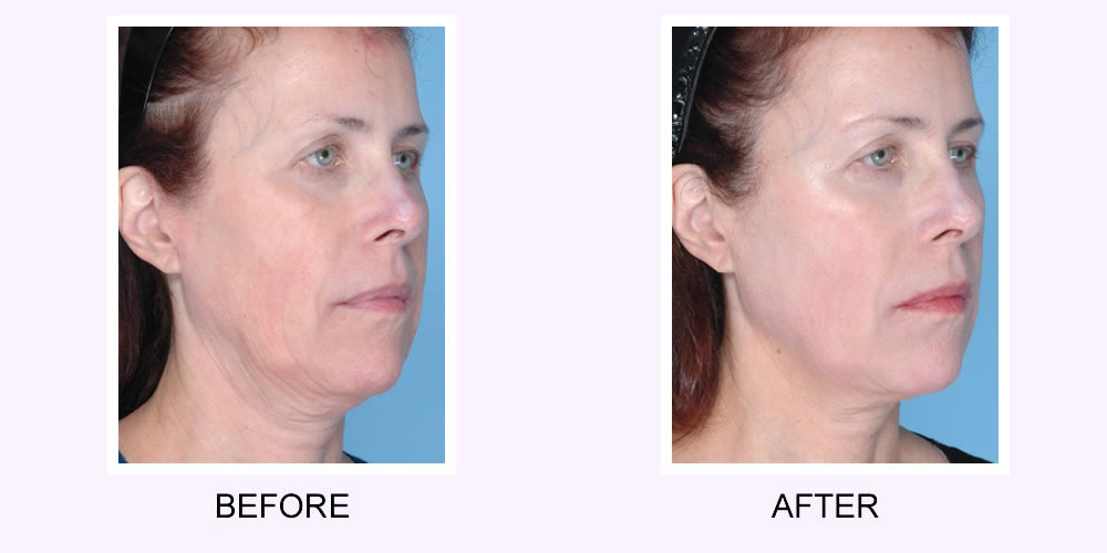 Ultherapy Before and After