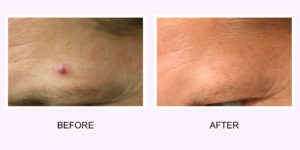 Vein Removal Before & After