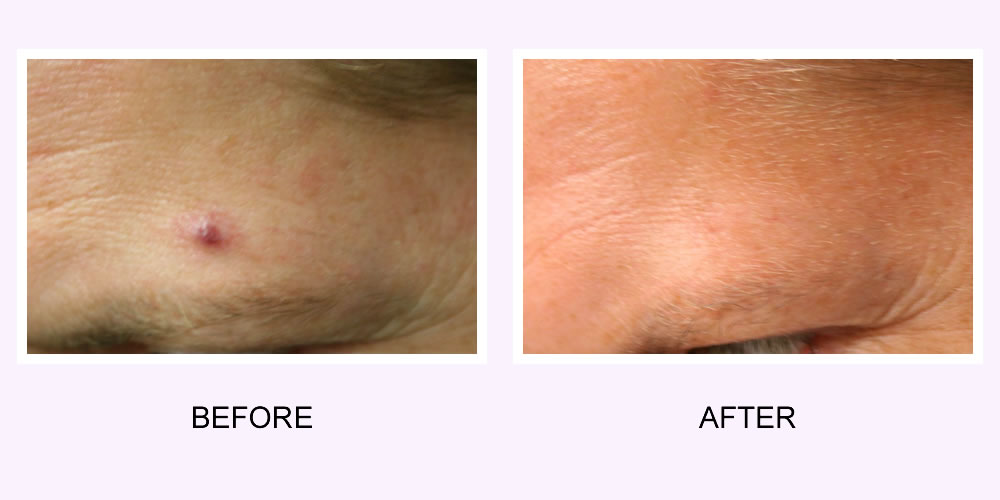 Vein Removal Before & After