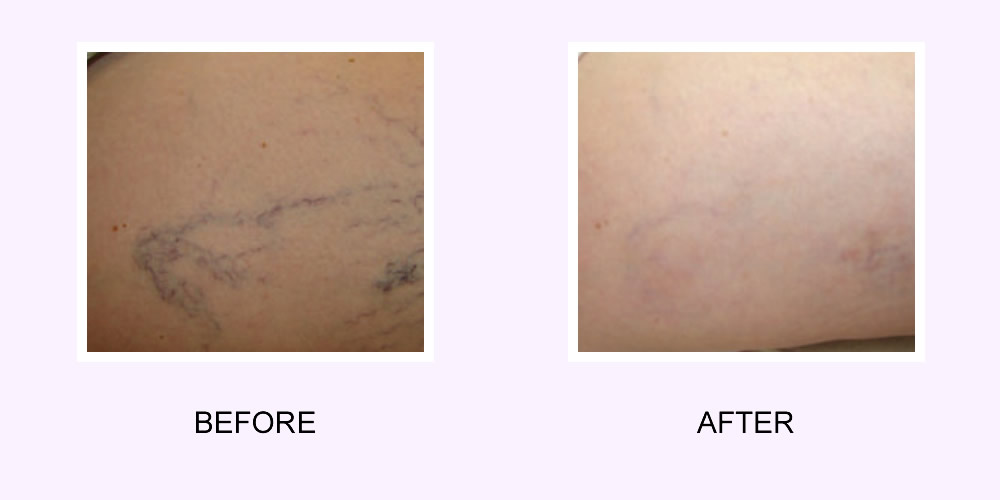 Vein Removal Before & After