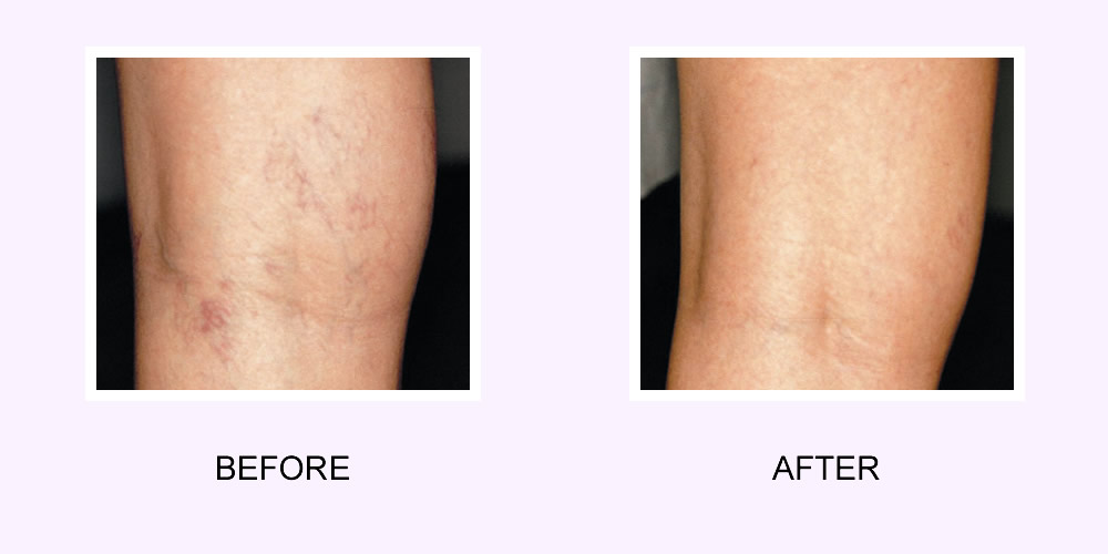 Laser Vein Removal Before & After