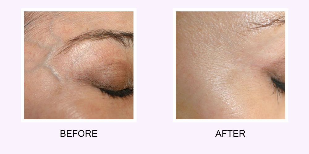 Vein Removal Before & After