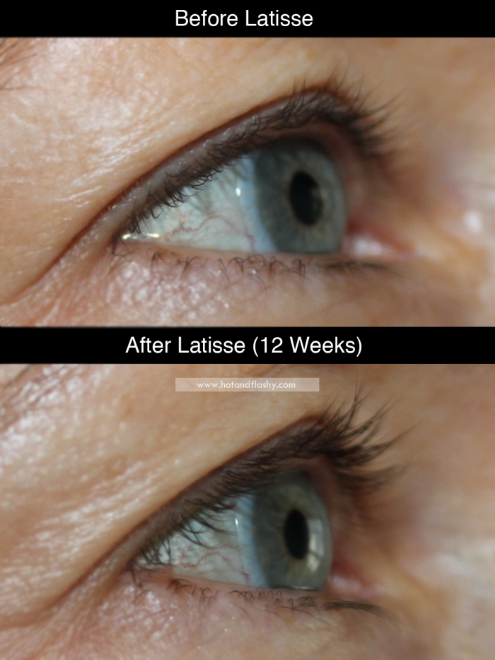 Latisse Before and After HotandFlashy50