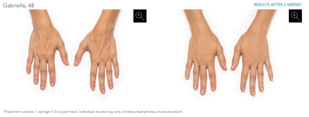 Radiesse before & after photo of hands