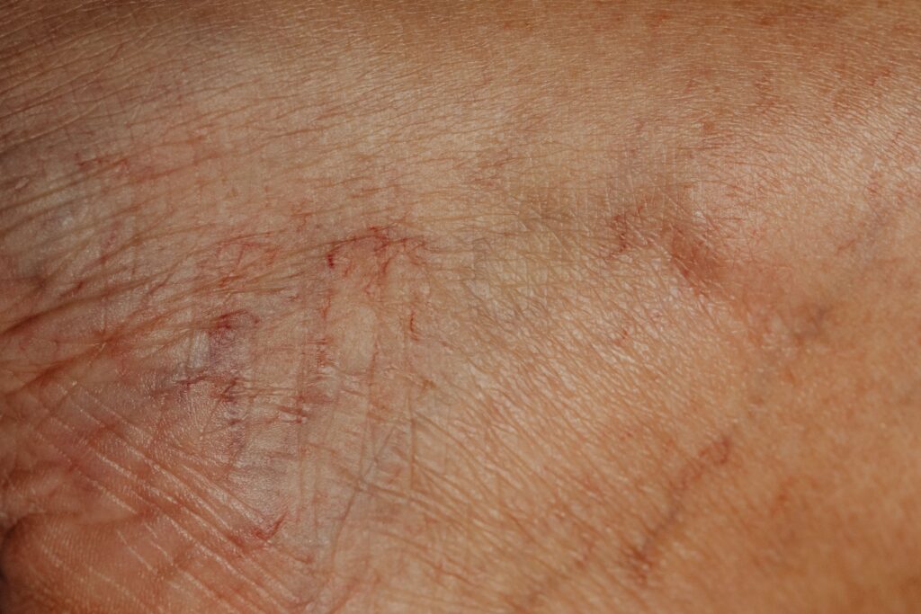 A close up image of varicose veins