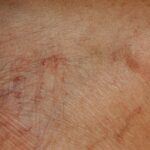 A close up image of varicose veins